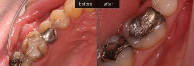 Amalgam Fillings