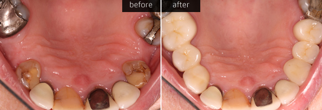 Lava / Zirconia Briges