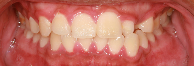 Periodontal Disease