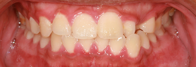 Periodontal Disease