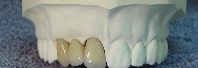 All Porcelain Crowns