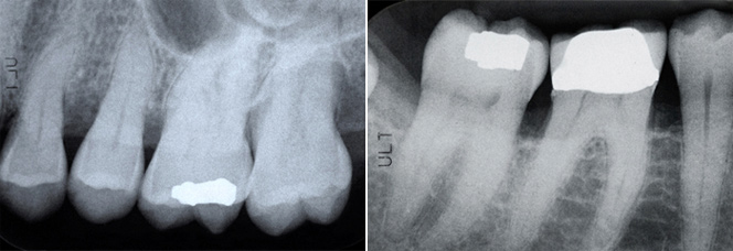 Root Canal