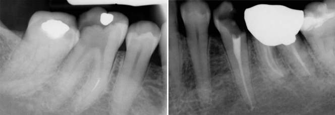 Root Canal