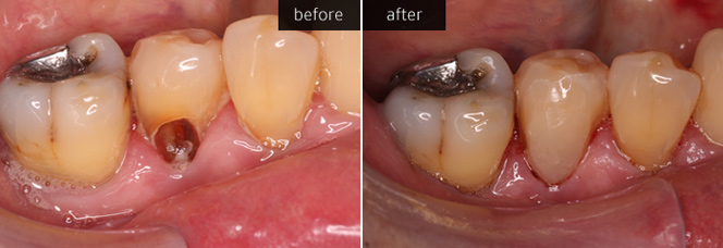 Tooth Coloured Fillings