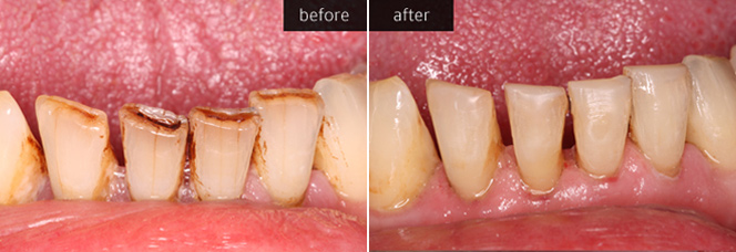 Tooth Coloured Fillings