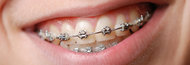 Traditional Braces