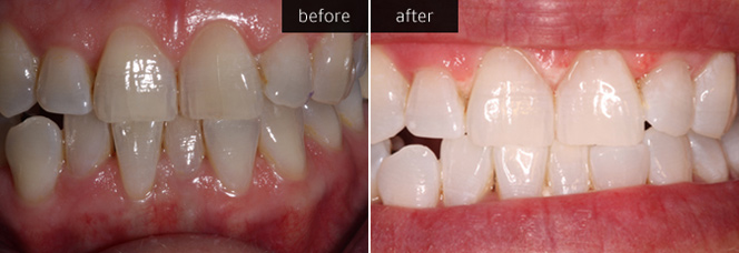 Tooth Whitening