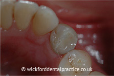 Amalgam Removals After